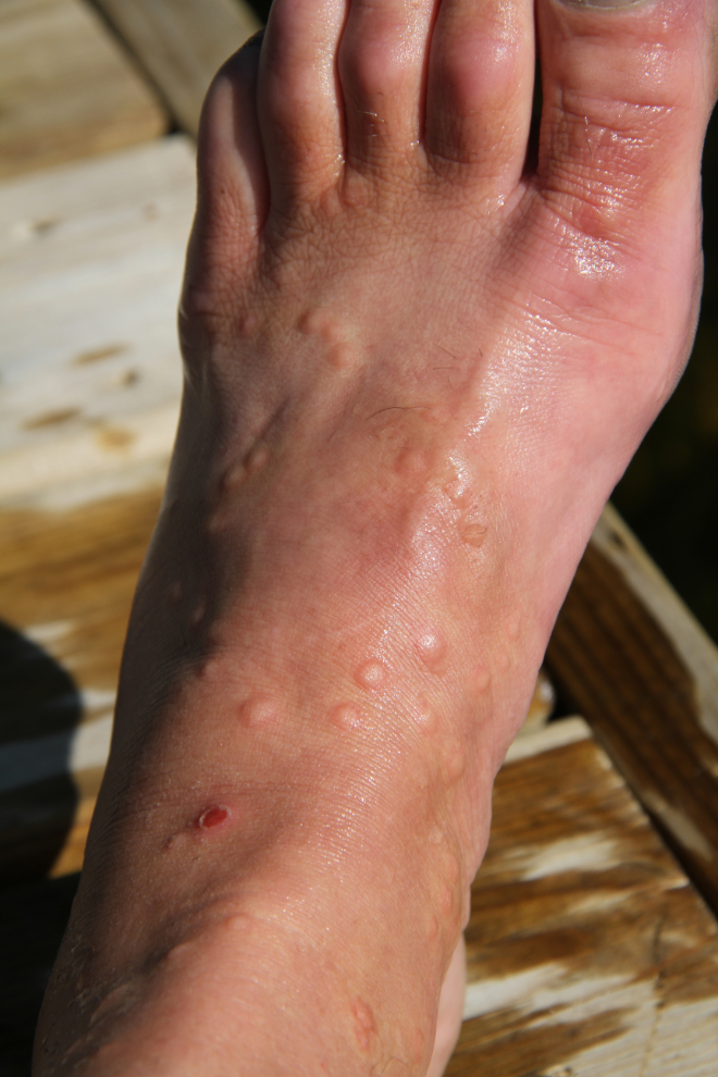 Bug bites on my feet